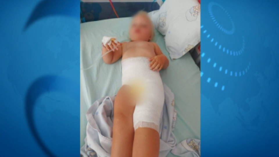 Дезинфектант причинил тежкото изгаряне на 2-годишното дете в ясла