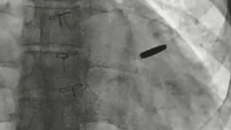 Войник, бранил "Азовстал", прекарал три години в руски плен с куршум в сърцето